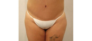 After Image: San Diego Patient Receives Tummy Tuck