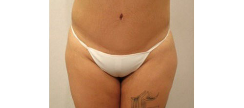 After Image: San Diego Patient Receives Tummy Tuck - front