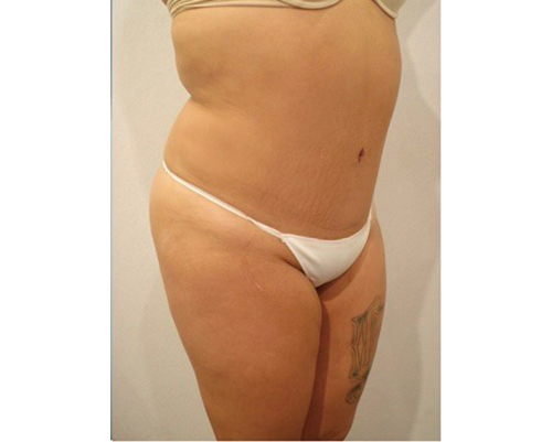 After Image: San Diego Patient Receives Tummy Tuck - right-front-oblique
