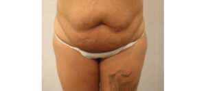 Before Image: San Diego Patient Receives Tummy Tuck