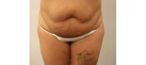 Before Image: San Diego Patient Receives Tummy Tuck - front