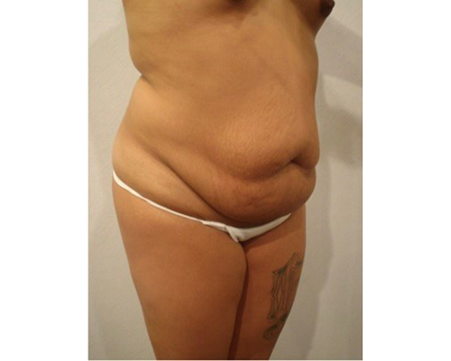 Before Image: San Diego Patient Receives Tummy Tuck - right-front-oblique