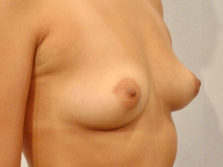 Before Image: SD Woman Receives Breast Augmentation, Enhancing Her Appearance and Confidence - right-front-oblique