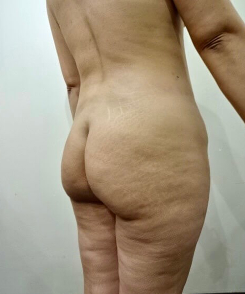 Before Image: Patient in San Diego, CA undergoes liposuction, body contouring, & BBL - right-back-oblique