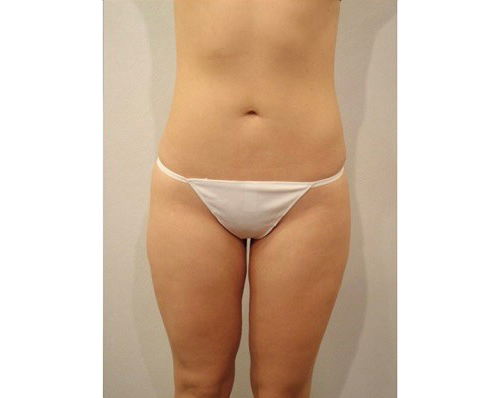After Image: San Diego Patient Receives Body Contouring, Liposuction - front