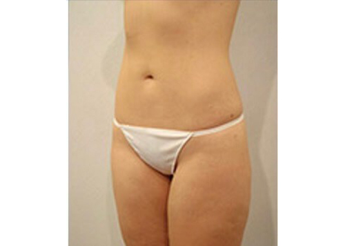 After Image: San Diego Patient Receives Body Contouring, Liposuction - left-front-oblique