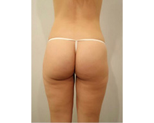 After Image: San Diego Patient Receives Body Contouring, Liposuction - back