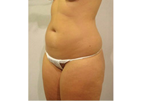 Before Image: San Diego Patient Receives Body Contouring, Liposuction - left-front-oblique