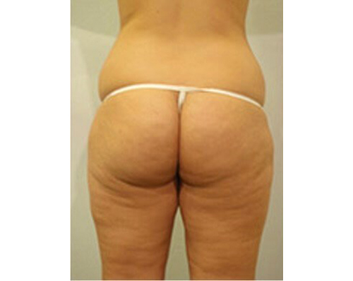 Before Image: San Diego Patient Receives Body Contouring, Liposuction - back