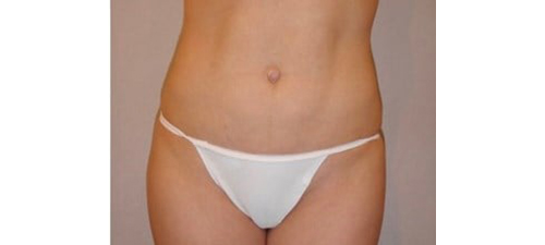 After Image: San Diego Patient Undergoes Liposuction and Body Contouring - front
