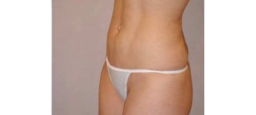 After Image: San Diego Patient Undergoes Liposuction and Body Contouring - left-front-oblique
