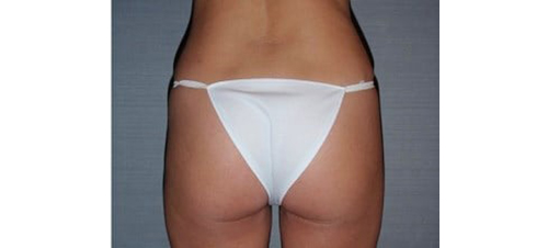 After Image: San Diego Patient Undergoes Liposuction and Body Contouring - back