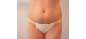 Before Image: San Diego, CA Patient Receives Body Contouring and Liposuction