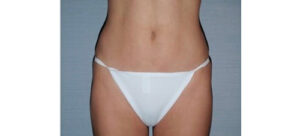 After Image: San Diego, CA Patient Receives Body Contouring and Liposuction