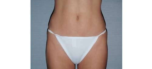 After Image: San Diego, CA Patient Receives Body Contouring and Liposuction - front