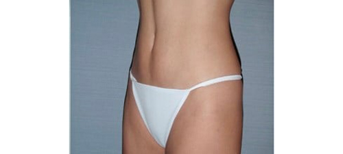 After Image: San Diego, CA Patient Receives Body Contouring and Liposuction - left-front-oblique