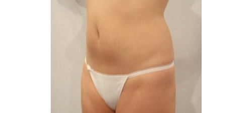 Before Image: San Diego, CA Patient Receives Body Contouring and Liposuction - left-front-oblique