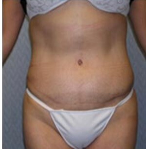 After Image: Patient in San Diego, CA Receives Tummy Tuck - front