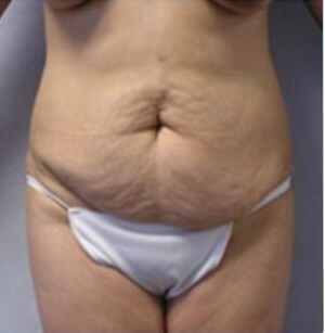Before Image: Patient in San Diego, CA Receives Tummy Tuck - front