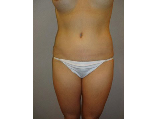 After Image: San Diego, CA Patient’s Tummy Tuck Procedure - front
