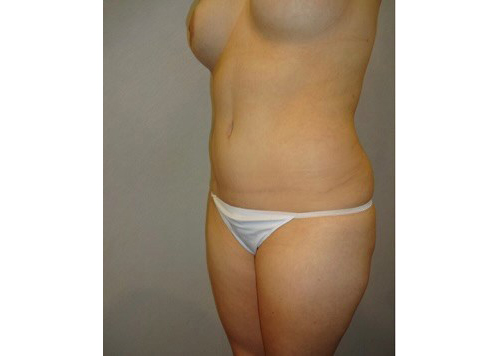 After Image: San Diego, CA Patient’s Tummy Tuck Procedure - left-front-oblique