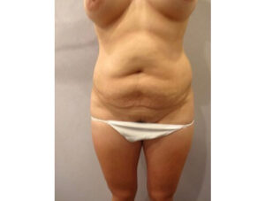 Before Image: San Diego, CA Patient’s Tummy Tuck Procedure
