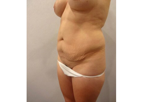 Before Image: San Diego, CA Patient’s Tummy Tuck Procedure - left-front-oblique