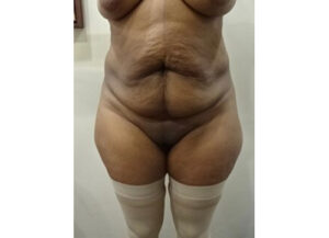 Before Image: Patient in San Diego, CA, Undergoes Tummy Tuck