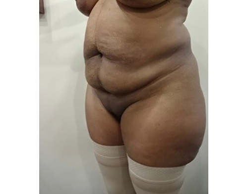Before Image: Patient in San Diego, CA, Undergoes Tummy Tuck - left-front-oblique
