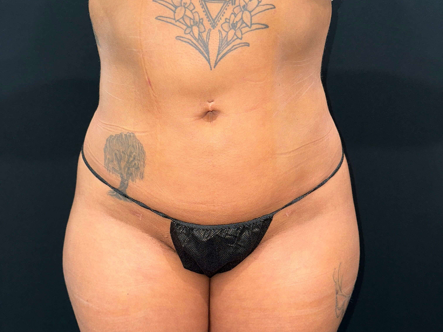 After Image: Patient in San Diego, CA, Undergoes Renuvion Skin Tightening and Liposuction - front