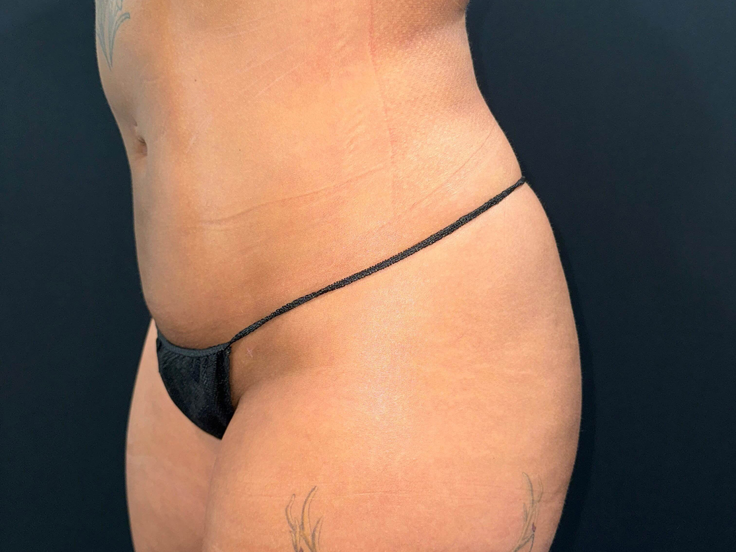 After Image: Patient in San Diego, CA, Undergoes Renuvion Skin Tightening and Liposuction - left-front-oblique