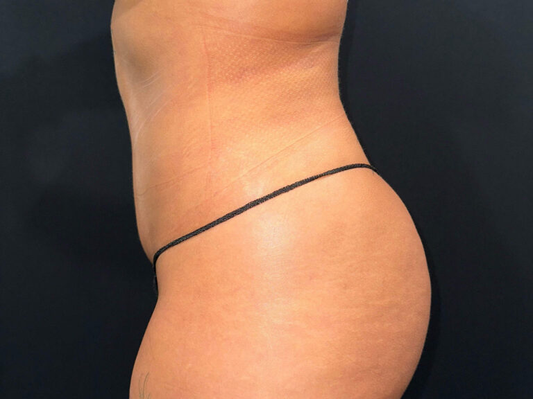 After Image: Patient in San Diego, CA, Undergoes Renuvion Skin Tightening and Liposuction - left-side