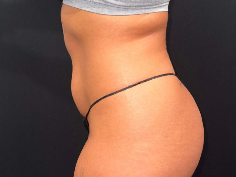 Before Image: Patient in San Diego, CA, Undergoes Renuvion Skin Tightening and Liposuction - left-side