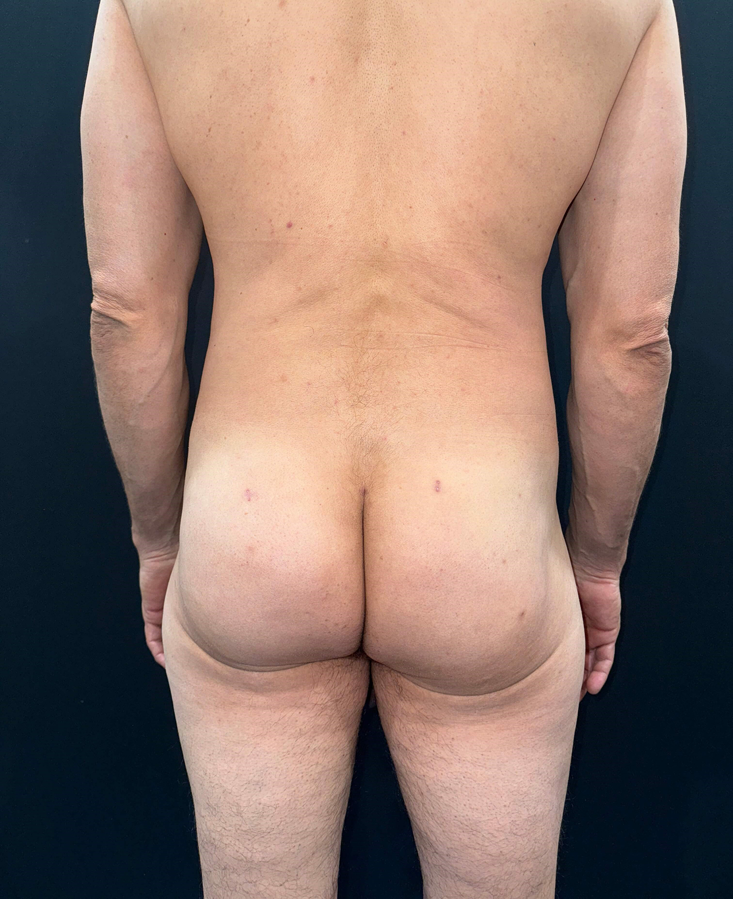 After Image: San Diego Patient Receives Body Contouring, Liposuction, Brazilian Butt Lift - back