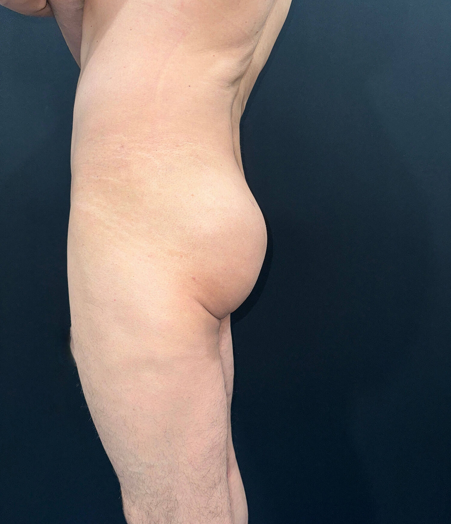 After Image: San Diego Patient Receives Body Contouring, Liposuction, Brazilian Butt Lift - left-side