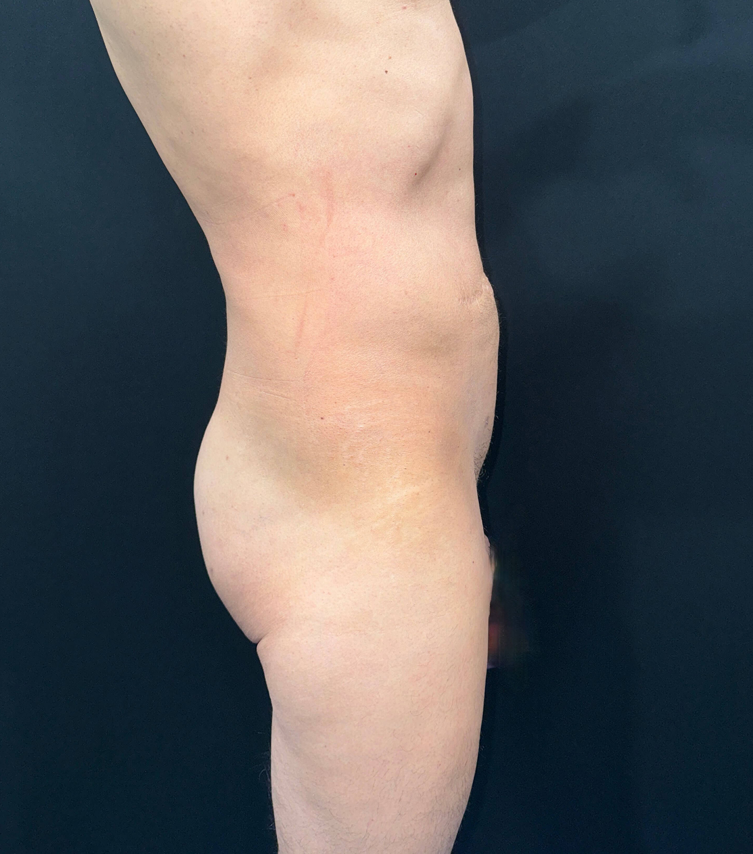 After Image: San Diego Patient Receives Body Contouring, Liposuction, Brazilian Butt Lift - right-side