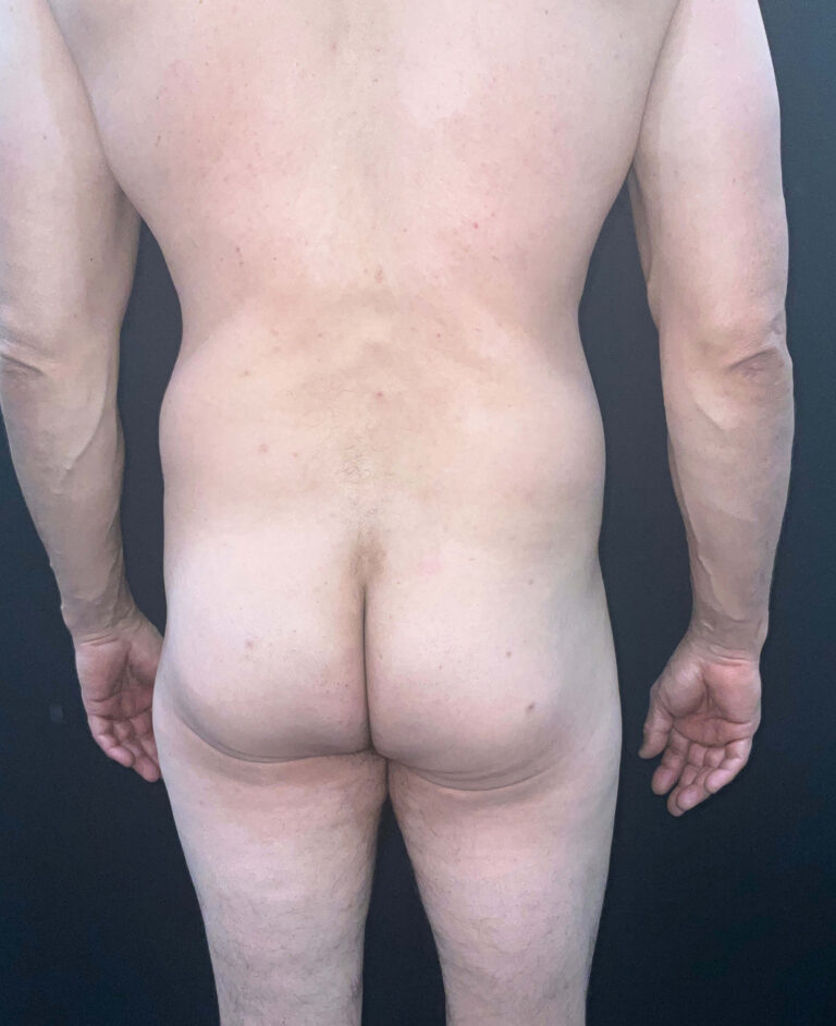 Before Image: San Diego Patient Receives Body Contouring, Liposuction, Brazilian Butt Lift - back