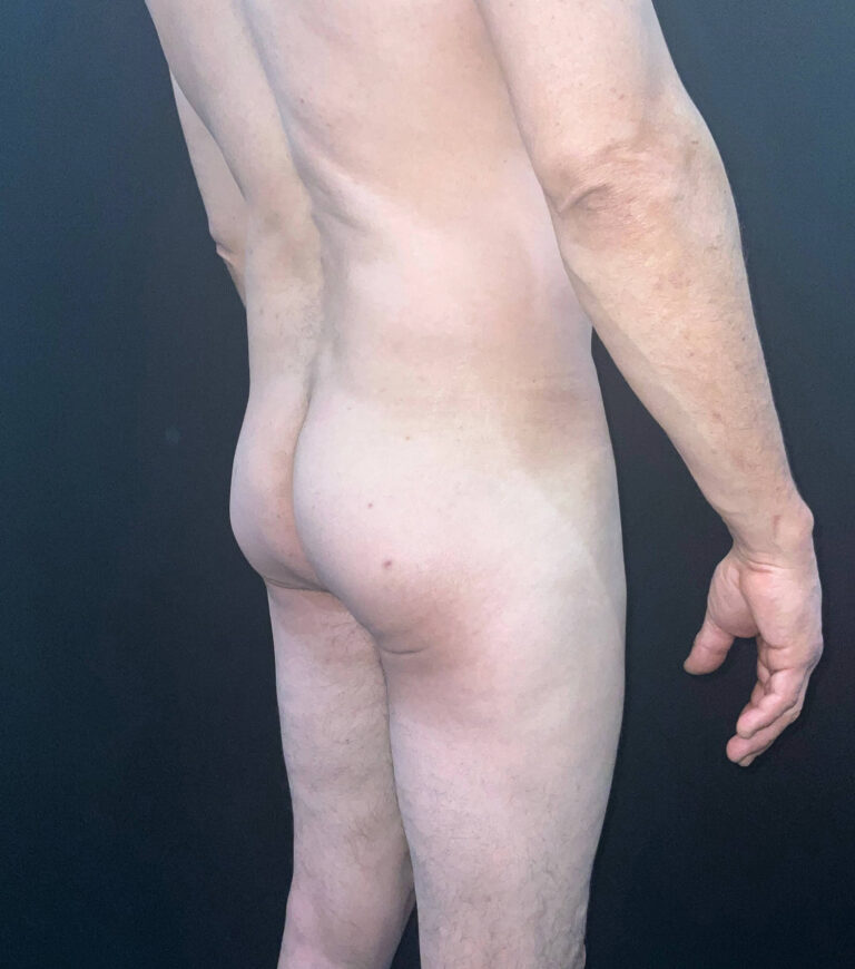 Before Image: San Diego Patient Receives Body Contouring, Liposuction, Brazilian Butt Lift - right-back-oblique