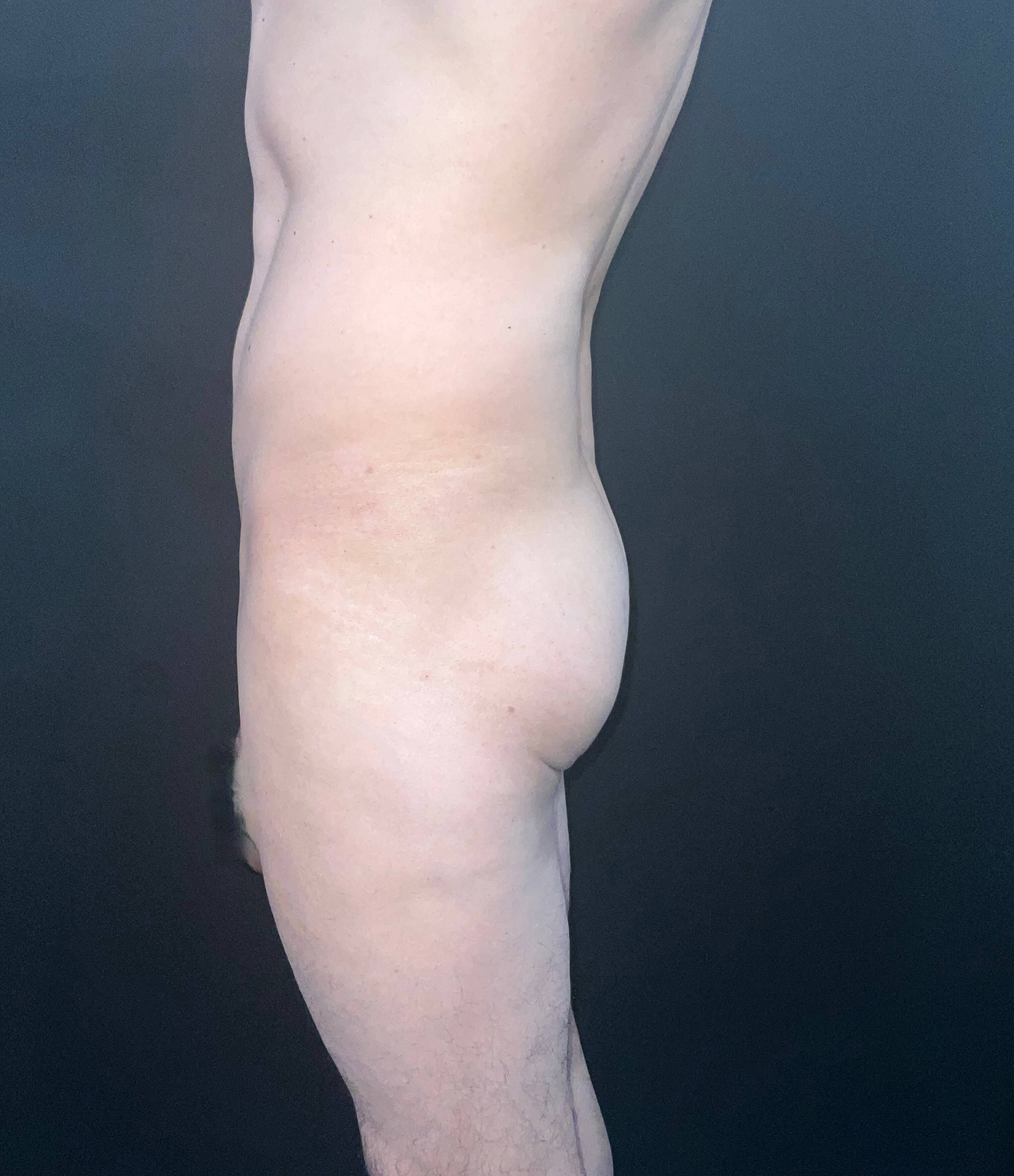 Before Image: San Diego Patient Receives Body Contouring, Liposuction, Brazilian Butt Lift - left-side