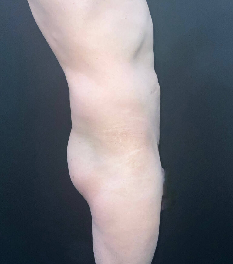 Before Image: San Diego Patient Receives Body Contouring, Liposuction, Brazilian Butt Lift - right-side