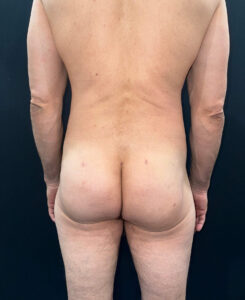 After Image: San Diego Patient Receives Body Contouring, Liposuction, Brazilian Butt Lift