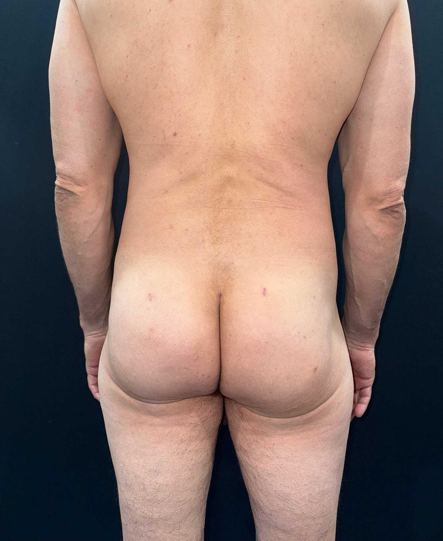 After Image: San Diego Patient Receives Body Contouring, Liposuction, Brazilian Butt Lift - back