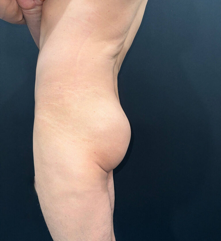 After Image: San Diego Patient Receives Body Contouring, Liposuction, Brazilian Butt Lift - left-side