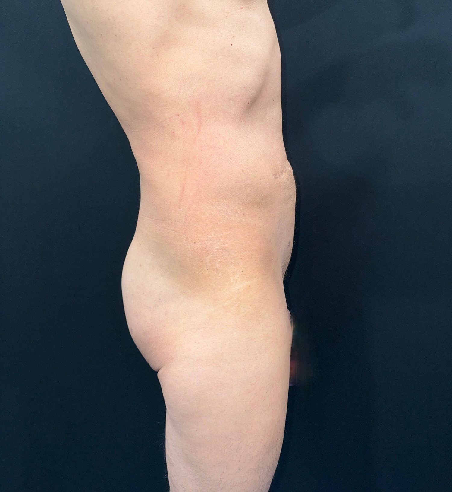 After Image: San Diego Patient Receives Body Contouring, Liposuction, Brazilian Butt Lift - right-side