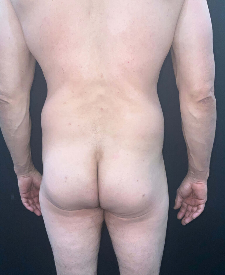 Before Image: San Diego Patient Receives Body Contouring, Liposuction, Brazilian Butt Lift - back