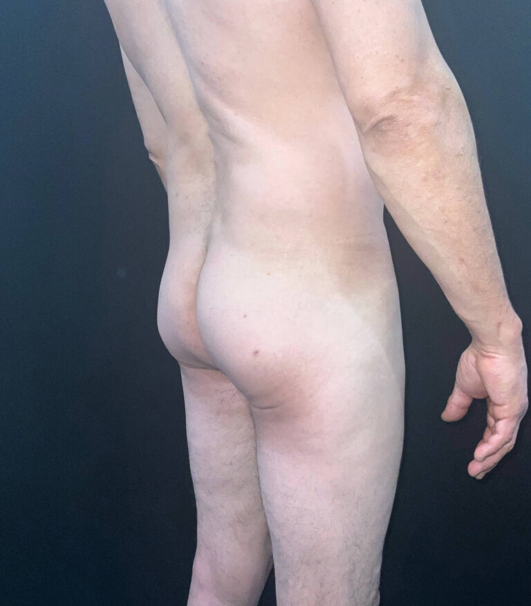 Before Image: San Diego Patient Receives Body Contouring, Liposuction, Brazilian Butt Lift - right-back-oblique