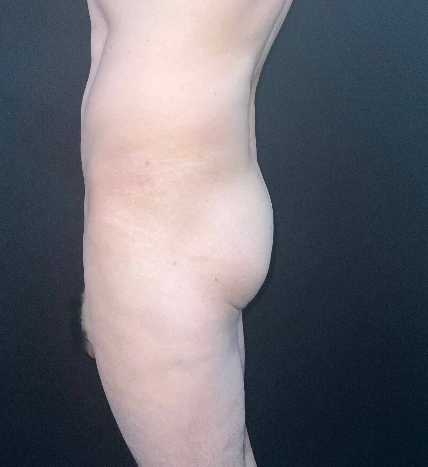 Before Image: San Diego Patient Receives Body Contouring, Liposuction, Brazilian Butt Lift - left-side