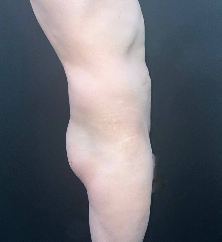 Before Image: San Diego Patient Receives Body Contouring, Liposuction, Brazilian Butt Lift - right-side