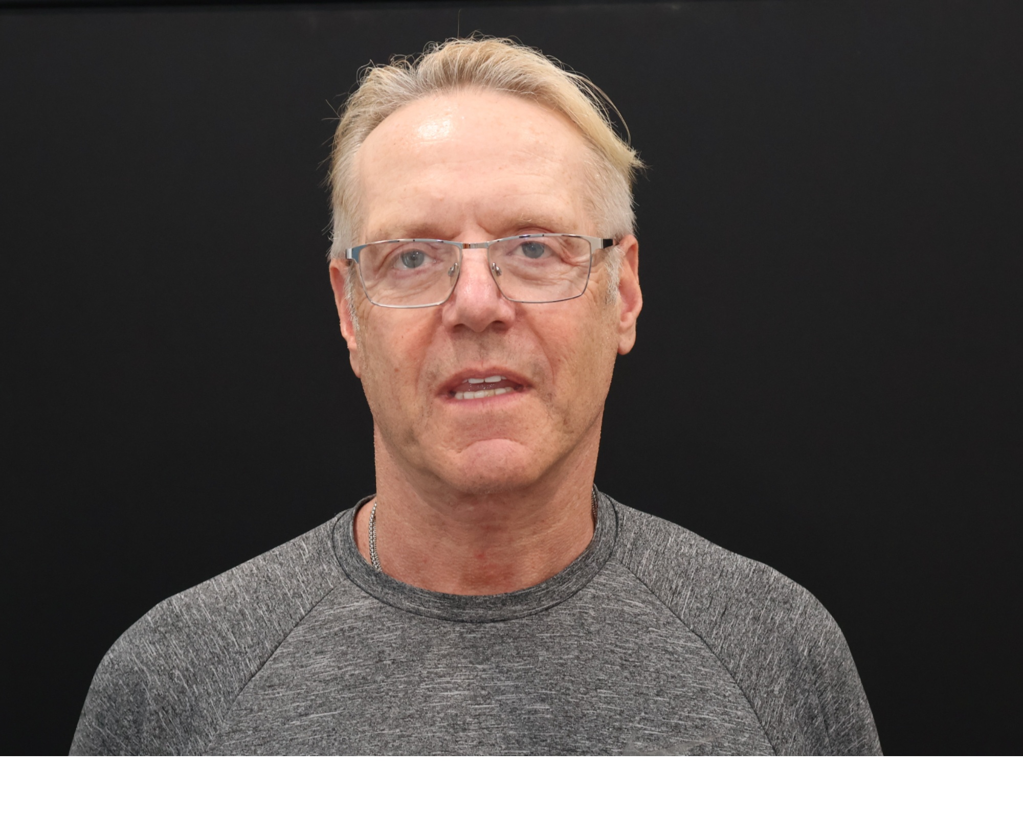 After Image: Necklift - front