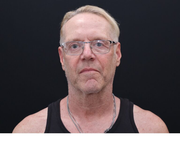 Before Image: Necklift - front